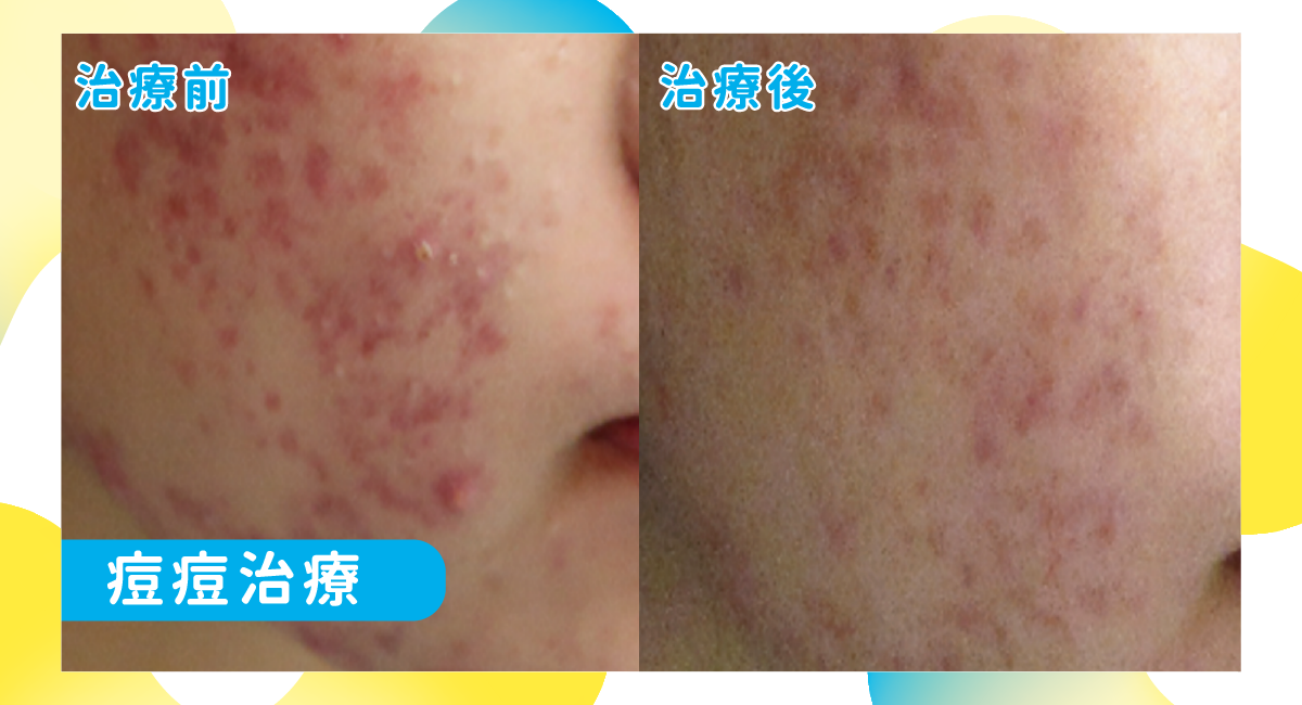 痘痘1
